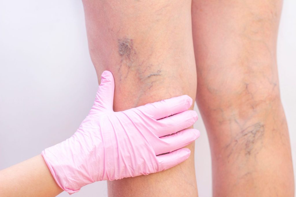 Small Varicose Veins